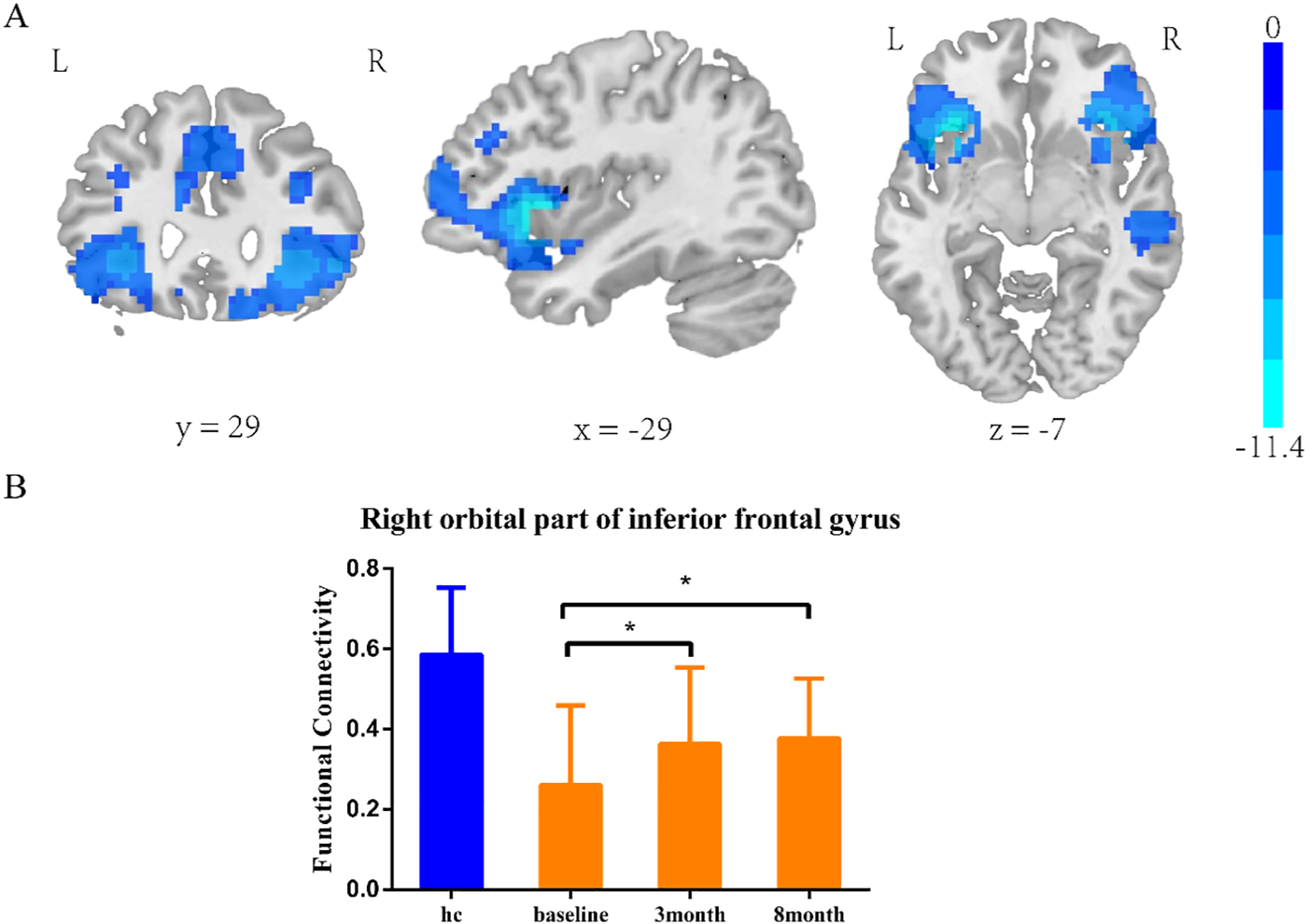 Panel A shows brain scans with color-coded areas highlighting connectivity differences in blue, with views at coordinates y=29, x=-29, and z=-7. Panel B is a bar graph labeled “Right orbital part of inferior frontal gyrus” showing functional connectivity values. The blue bar represents a control group, and the orange bars represent baseline, three-month, and eight-month follow-up data. Asterisks indicate significant differences between the groups.