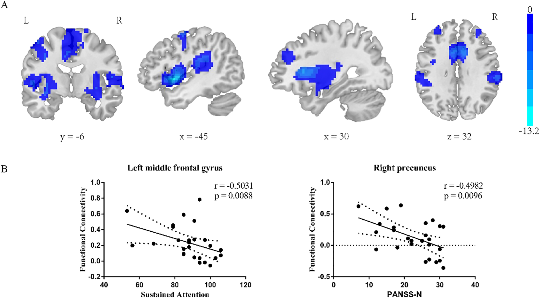 Panel A shows brain scans highlighting areas of activation in blue at various coordinates: y = -6, x = -45, x = 30, z = 32. Panel B includes two scatter plots. The left plot shows a negative correlation between functional connectivity in the left middle frontal gyrus and sustained attention (r = -0.5031, p = 0.0088). The right plot depicts a negative correlation between functional connectivity in the right precuneus and PANSS-N scores (r = -0.4982, p = 0.0096).