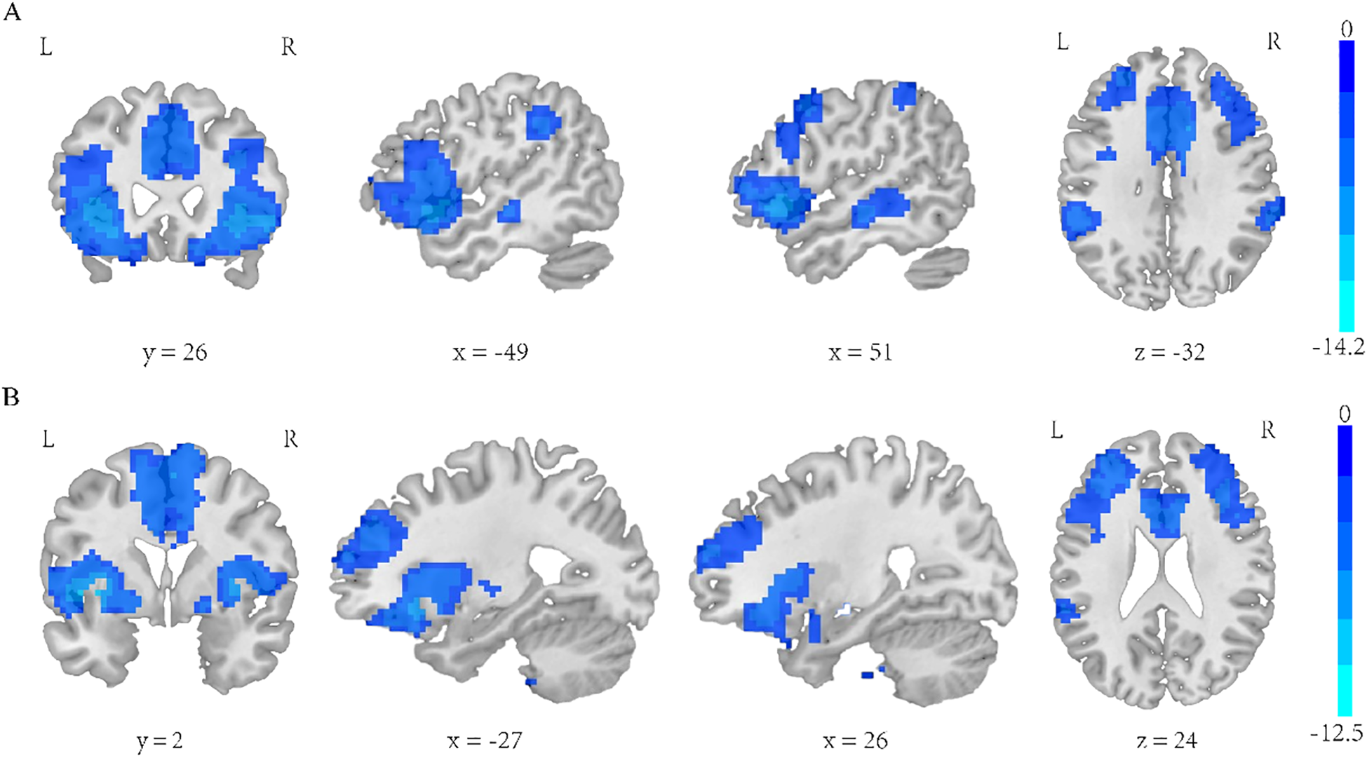 Two sets of brain MRI scans display different sections with highlighted areas in blue, indicating significant regions of interest. Panel A shows coronal, sagittal, and axial views with coordinates y=26, x=-49, x=51, and z=-32. Panel B similarly includes coronal, sagittal, and axial views with coordinates y=2, x=-27, x=26, and z=24. A color bar on the right indicates intensity levels ranging from 0 to -14.2 for panel A and 0 to -12.5 for panel B.