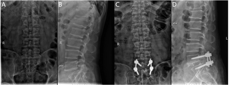X-ray images displaying the lumbar spine in anterior-posterior and lateral views. Panel A and B show the spine without hardware, while panels C and D show a stabilized spine with screws and rods implanted.