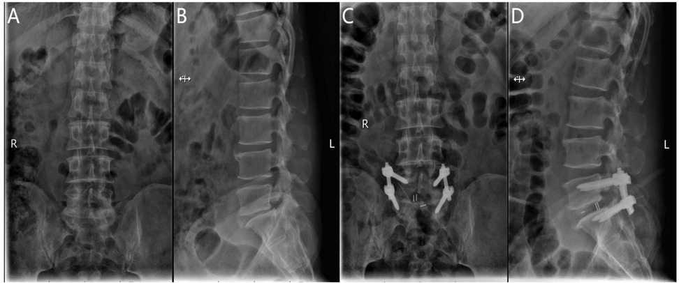 Series of four X-ray images of the lumbar spine. Image A shows an anteroposterior view without surgical hardware, while image B provides a lateral view. Images C and D show the same views post-surgery, with visible hardware in place for spinal stabilization.