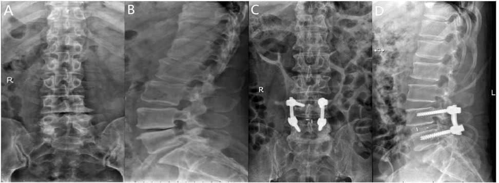 Four-panel X-ray image of the lumbar spine. Panel A shows a frontal view of the spine with vertebrae visible. Panel B provides a lateral view of the spine. Panel C displays a frontal view with surgical hardware, indicating spinal screws and rods. Panel D shows a lateral view with the same hardware, emphasizing lumbar fixation.