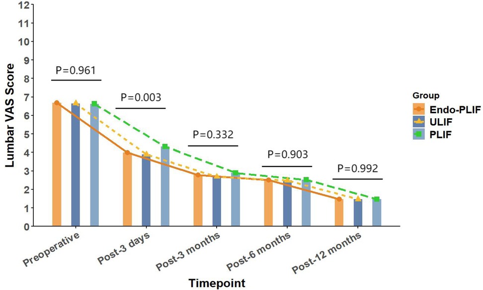Bar chart illustrating ODI scores over various timepoints for three groups: Endo-PLIF, ULIF, and PLIF. Scores decrease from preoperative to post-twelve months. P-values indicate statistical differences between groups at each timepoint.