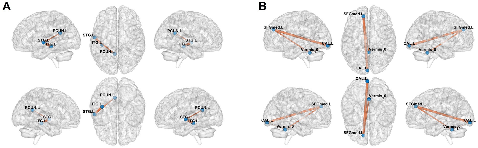 Four diagrams of the human brain showing different lateral view connectivity pathways. Panel A highlights links between PCUN.L, STG.L, and ITG.L. Panel B shows connections involving SFGmed.L, CAL.L, and Vermis_1_0. Orange lines represent pathways, and blue dots mark specific brain regions.