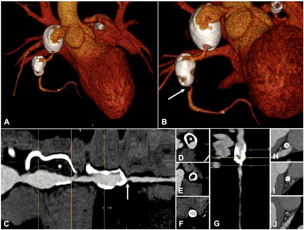 A collection of medical imaging panels showing a detailed view of the heart and blood vessels. Panels A and B display 3D rendered images highlighting aneurysms in white against the red heart. Panel C presents a cross-sectional view marked with an asterisk and an arrow. Panels D to J contain various cross-sectional scans with distinct features and markers, illustrating different views and sections of the vasculature related to the heart, emphasizing areas of clinical interest.