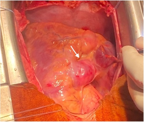Open surgical view of a human heart, surrounded by tissue and organs, with a medical instrument held by a gloved hand on the right side.