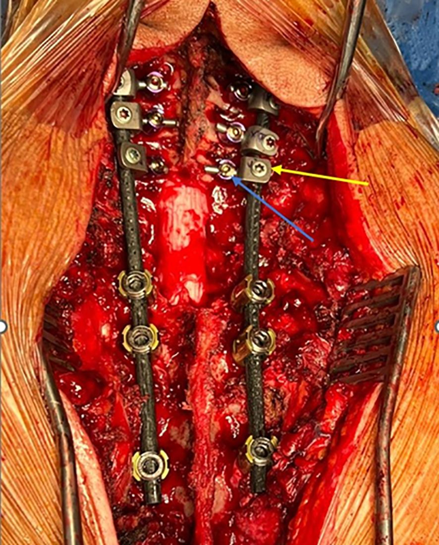 Surgical view of a spine with metal rods and screws in place, indicating spinal stabilization hardware. Tissue is exposed, with yellow and blue arrows pointing toward specific components, possibly highlighting details for educational purposes.