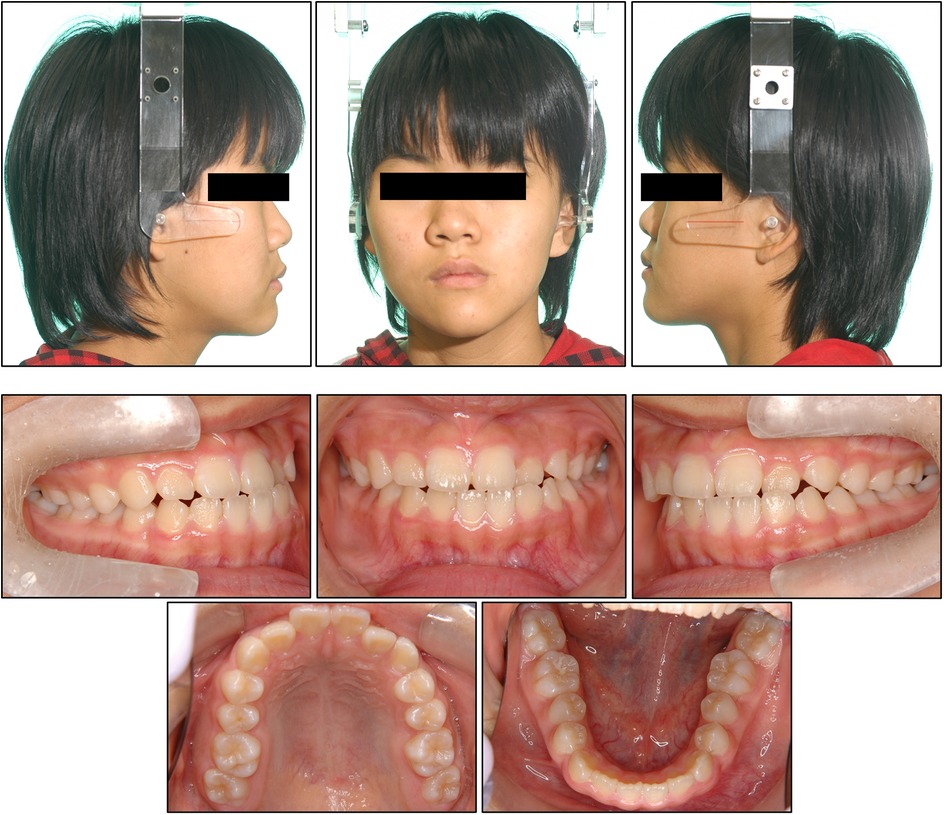 A series of images showing a person viewed from the side and front, along with close-ups of dental alignment. The dental images show the bite from various angles, as well as views of the upper and lower teeth occlusions.