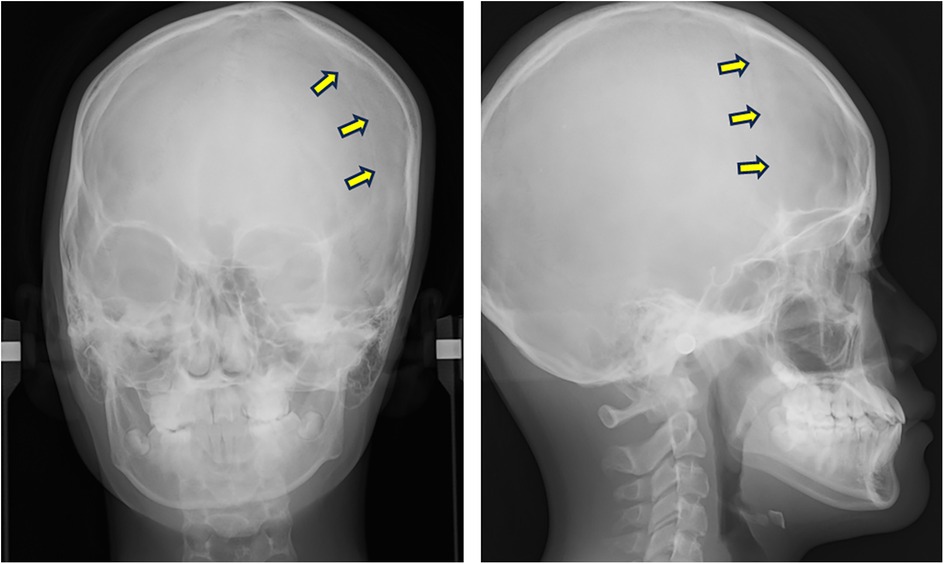 Two X-ray images of a skull. The left image shows a front view with three yellow arrows indicating an area on the forehead. The right image displays a side view, also with three yellow arrows pointing to the same region on the skull.