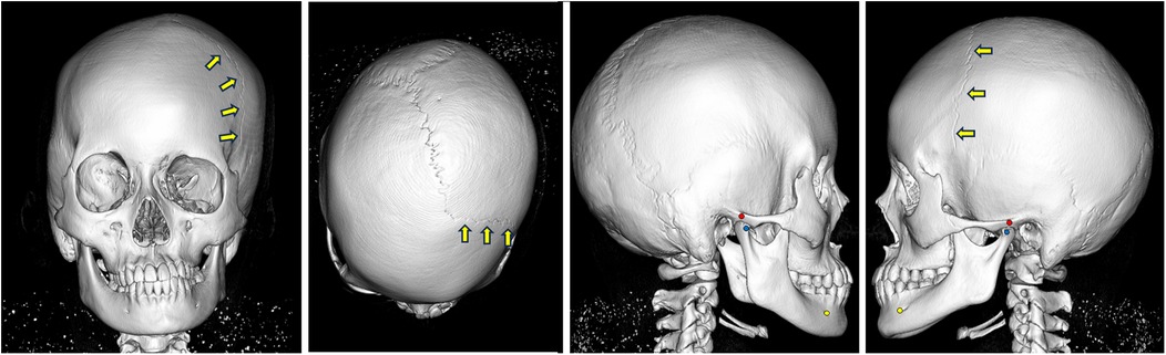 A series of four 3D-rendered skull images from different angles: frontal, top, and two side views. Yellow arrows highlight specific points, likely indicating anatomical features or points of interest on the cranial structure in each image. One side view includes a red dot near the ear and a yellow dot below the jaw, which may mark significant locations for medical or educational reference.