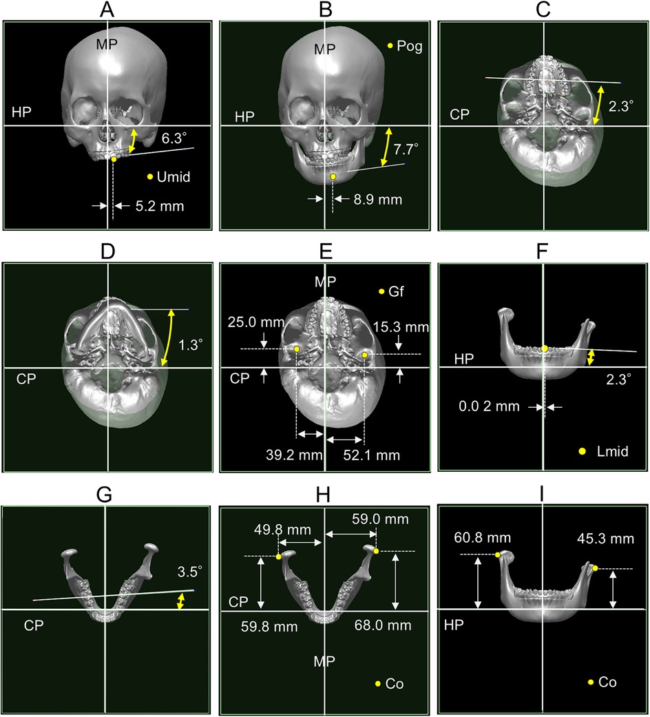 Skull and mandible CT images with measurements and annotations. Panels A to I show different views and dimensions, indicating angles and distances in millimeters. Notable points include Umid, Pog, Gf, Co, and Lmid. Measurements correspond to coordinate planes (HP, CP, and MP), illustrating anatomical differences and alignments.