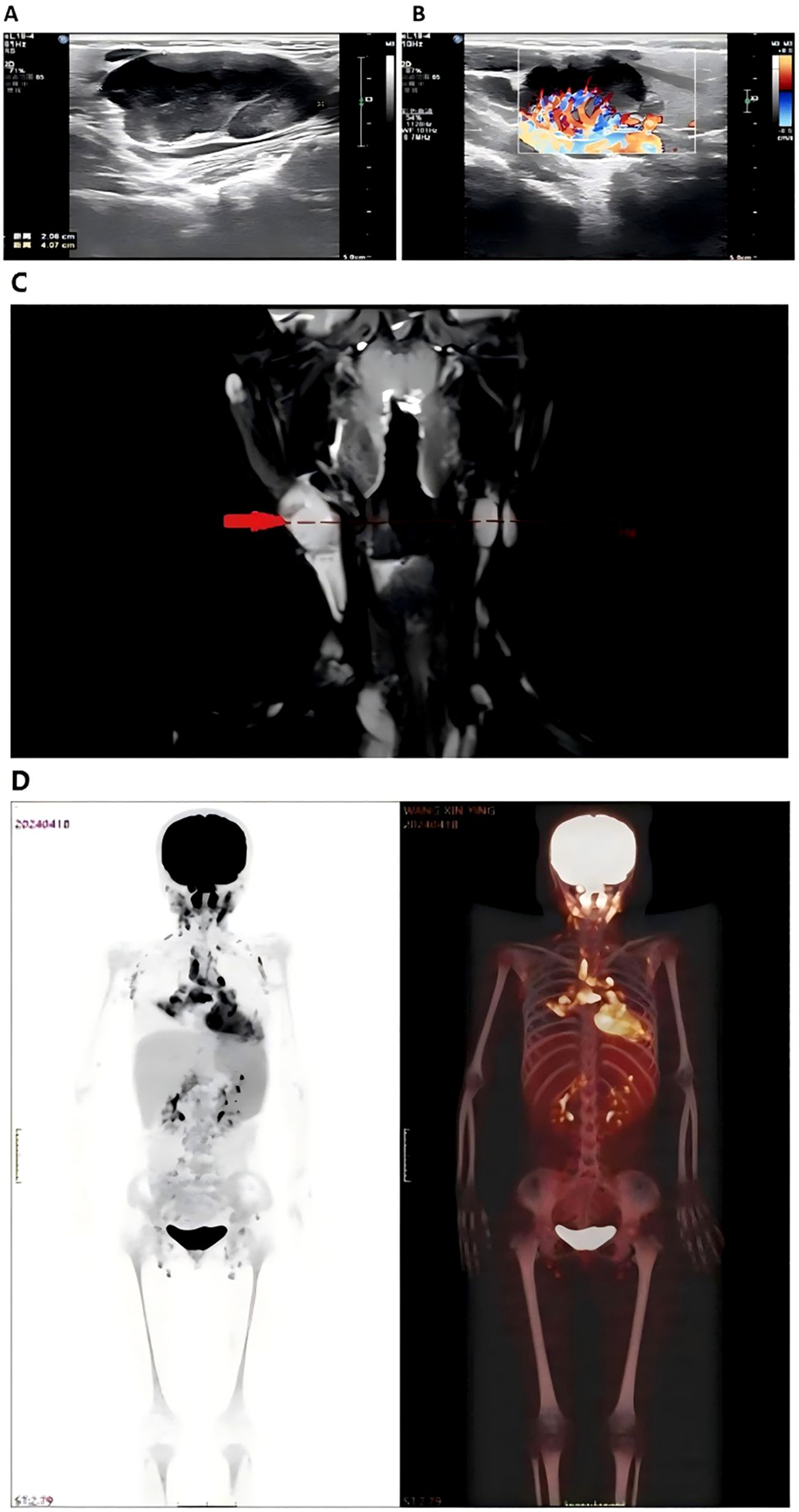 Panel A shows an ultrasound of a mass measuring 2.06 cm by 4.07 cm. Panel B displays a color Doppler ultrasound illustrating blood flow within the mass. Panel C is an MRI scan with a red arrow indicating a specific area of interest. Panel D features two full-body scans: a PET scan on the left shows areas of high uptake, and a combined PET/CT scan on the right highlights skeletal and organ structures.