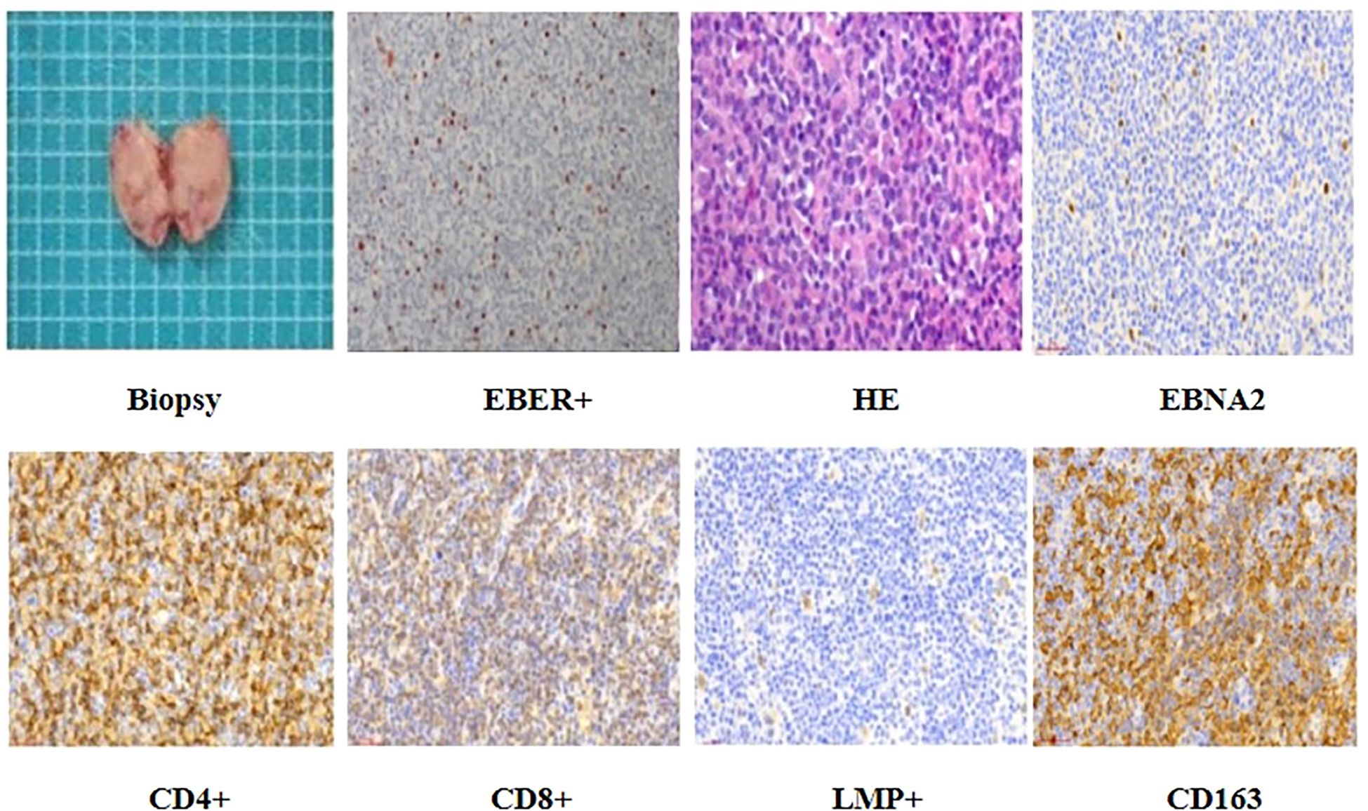 A series of eight images showing different biopsy and staining results. The first image is a biopsy specimen on a grid background. The following images display histological stains: EBER positive, hematoxylin and eosin (HE), and EBNA2. The bottom row shows CD4+, CD8+, LMP+, and CD163 staining, highlighting varied cellular characteristics and markers.
