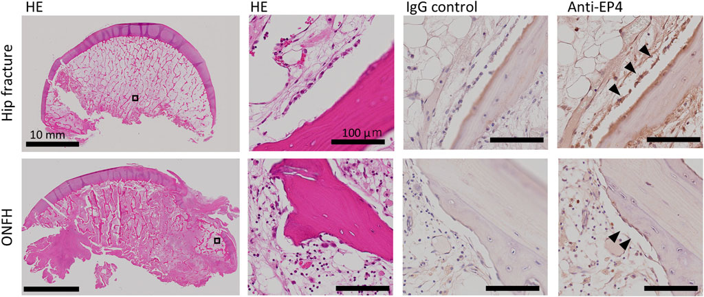 Histological images compare hip fracture (top row) and osteonecrosis of the femoral head (ONFH, bottom row). Each row shows four sections: HE staining, close-up HE staining, IgG control, and Anti-EP4 staining. HE sections reveal bone structure, while IgG control ensures staining specificity. Anti-EP4 sections highlight EP4 expression with arrowheads indicating positive staining. Scales are provided for reference.
