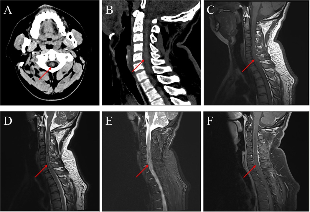 Radiographic images show various views of the cervical spine. Image A is an axial CT scan highlighting the spinal canal with a red arrow. Image B shows a sagittal CT scan with a red arrow indicating a vertebral anomaly. Images C, D, E, and F are sagittal MRI scans of the spine, each marked with a red arrow pointing to areas of interest along the spinal column, possibly indicating a lesion or irregularity.