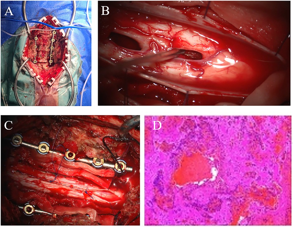 Panel A shows a spinal surgery with exposed vertebrae and instrumentation. Panel B depicts a close-up view of spinal tissue during surgery. Panel C shows a metal stabilizer attached to spinal bones. Panel D displays a histological slide with pink and red stained tissue.