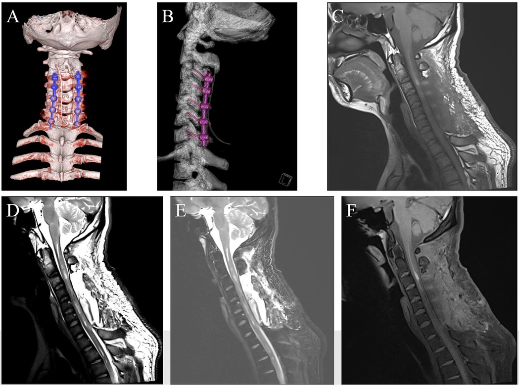 Anatomical and MRI images of the cervical spine. Image A is a 3D reconstruction of the cervical spine with highlighted areas in blue indicating particular focus. Image B shows a lateral view with pink markers on the spine. Images C to F are MRI scans displaying various sagittal views of the cervical spine, showing varying degrees of detail in the spinal structure and surrounding tissues.