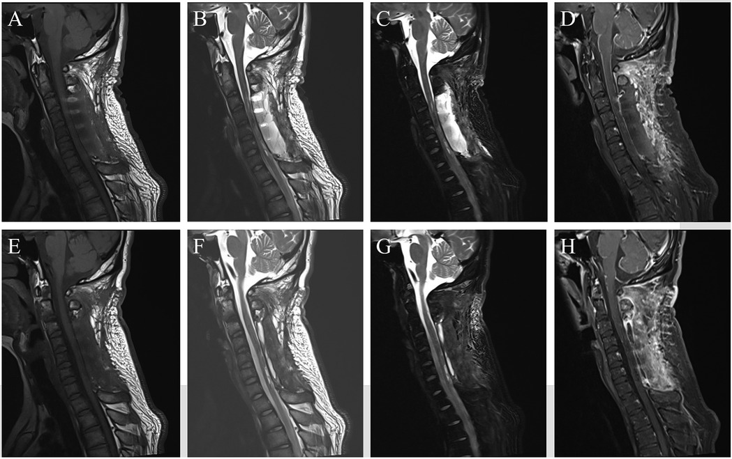 MRI images of the cervical spine in sagittal view, grouped in two rows labeled A to H. Each image shows different contrasts and conditions of the spine and surrounding tissue, likely illustrating various abnormalities or pathologies.