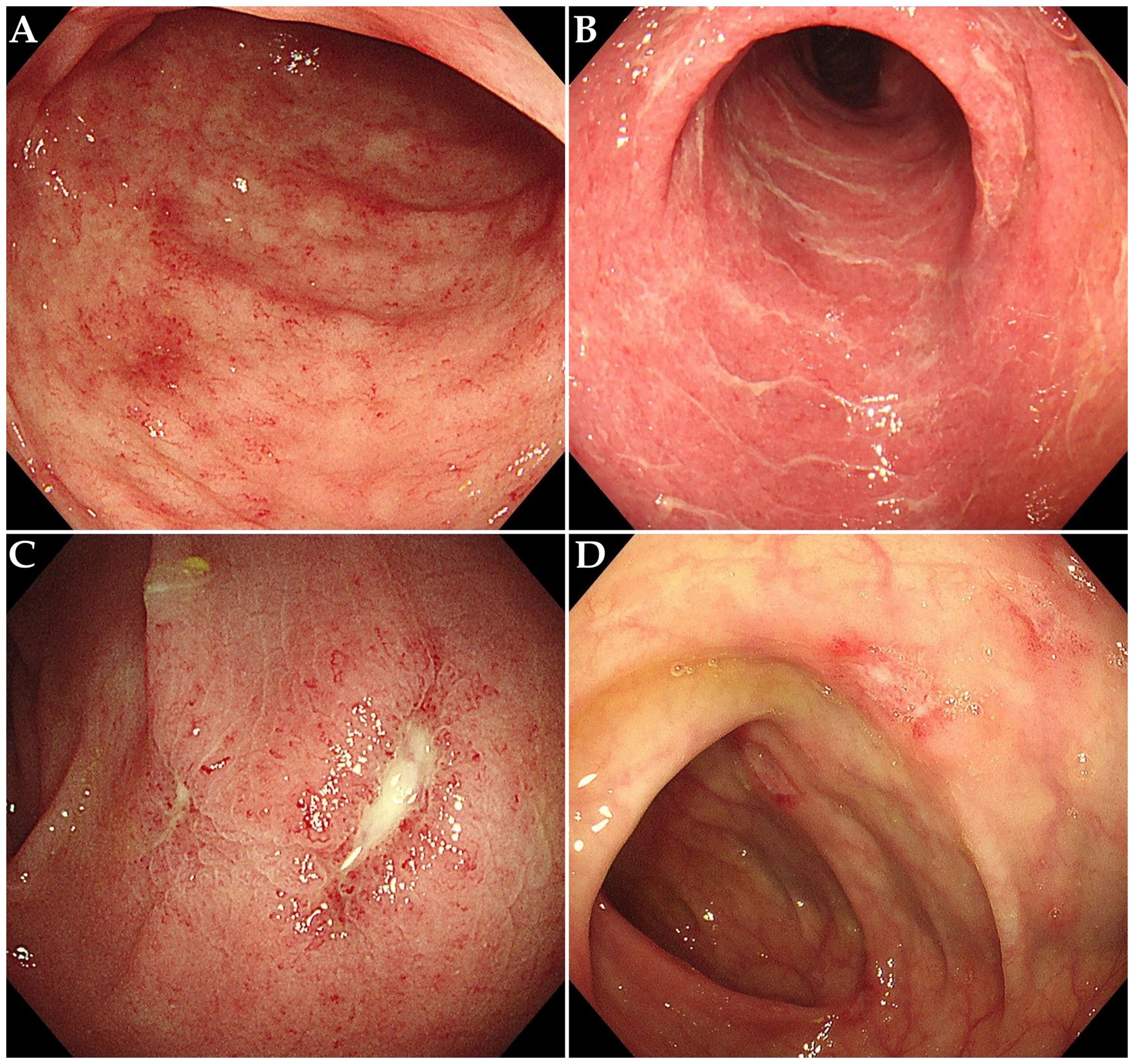 Four endoscopic images of the colon showing different conditions. Image A depicts diffuse erythema with fine granularity. Image B shows mucosal edema and disappearance of vascular patterns. Image C and D show multiple ulcerative lesions.