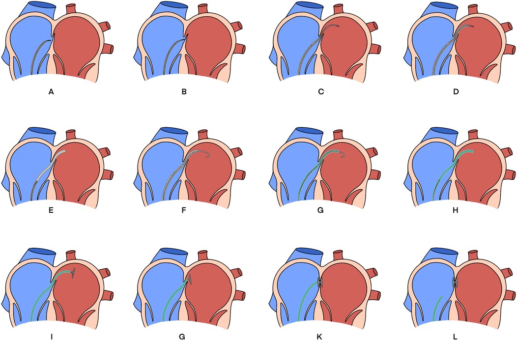 Twelve-panel illustration of a heart procedure using a catheter. Each panel, labeled A through L, shows progressive stages of the catheter's advancement through the heart chambers, demonstrating its path for a medical intervention.