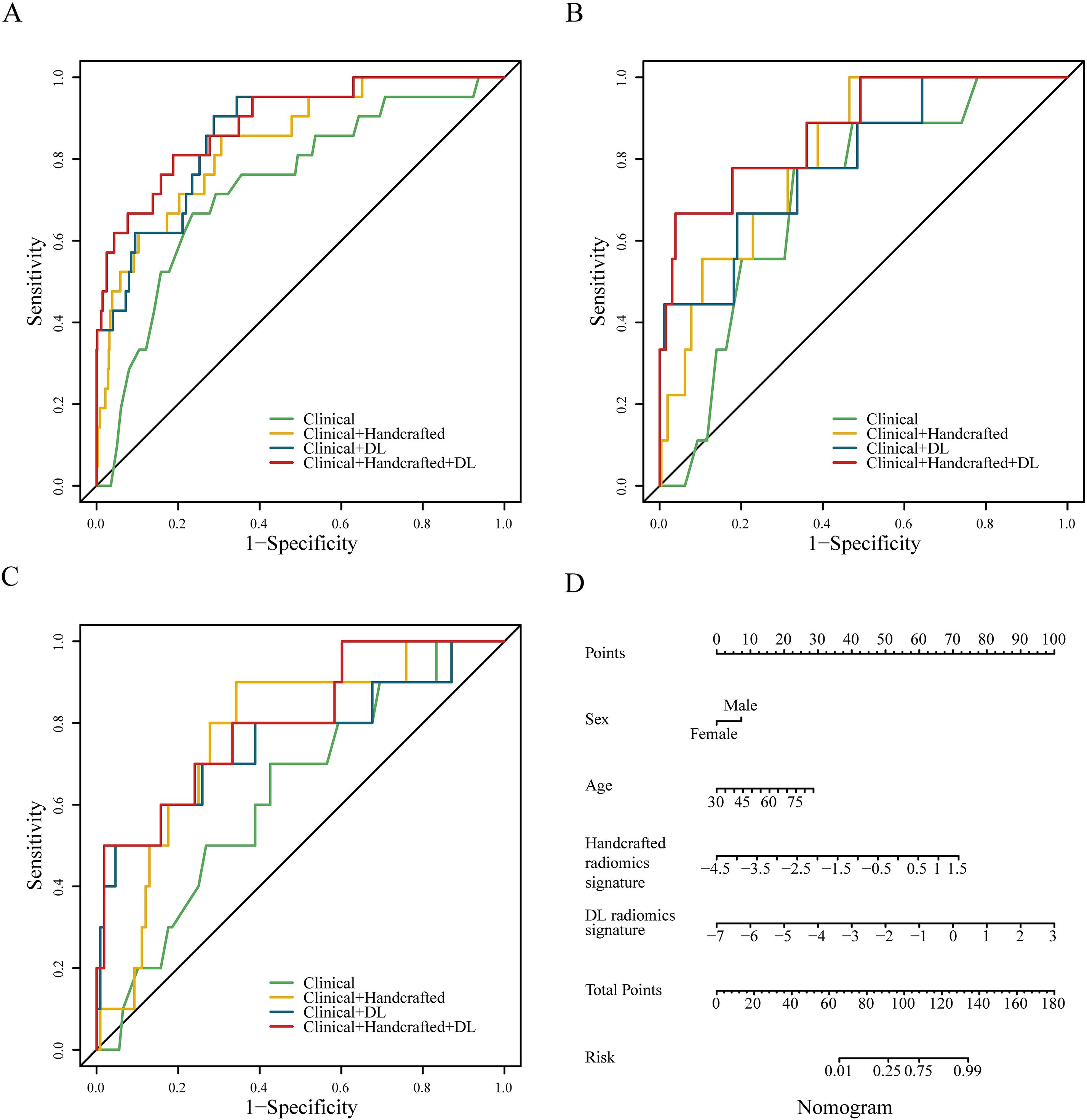 Image includes three ROC curve plots labeled A, B, and C, illustrating the sensitivity versus one minus specificity for various models: Clinical, Clinical plus Handcrafted, Clinical plus DL, and Clinical plus Handcrafted plus DL. Plot D is a nomogram, correlating patient characteristics and radiomics signatures to total points and risk.