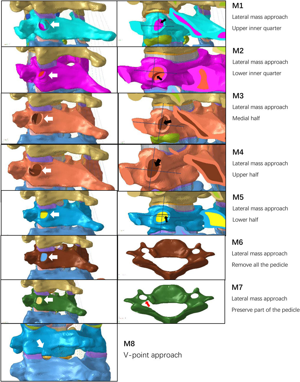 Series of medical 3D renderings showing different spinal approaches labeled M1 to M8. Each image depicts a portion of the spine with color-coded annotations and arrows indicating specific areas. M1 to M5 illustrate lateral mass approaches, focusing on various quarters and halves of the structure. M6 and M7 highlight the pedicle, with M6 showing complete removal and M7 partial preservation. M8 illustrates a V-point approach. Annotations and arrows indicate precise areas of interest for each approach.
