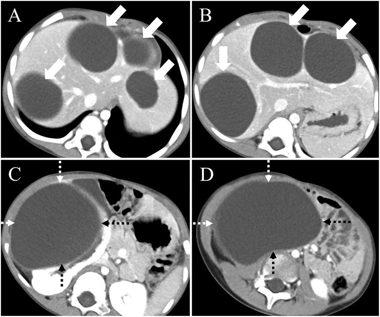 CT scans of an abdomen in four panels labeled A to D. Panels A and B show multiple round structures with white arrows indicating points of interest. Panels C and D focus on a large round structure, highlighted by dashed arrows pointing to specific areas, indicating notable features or anomalies.