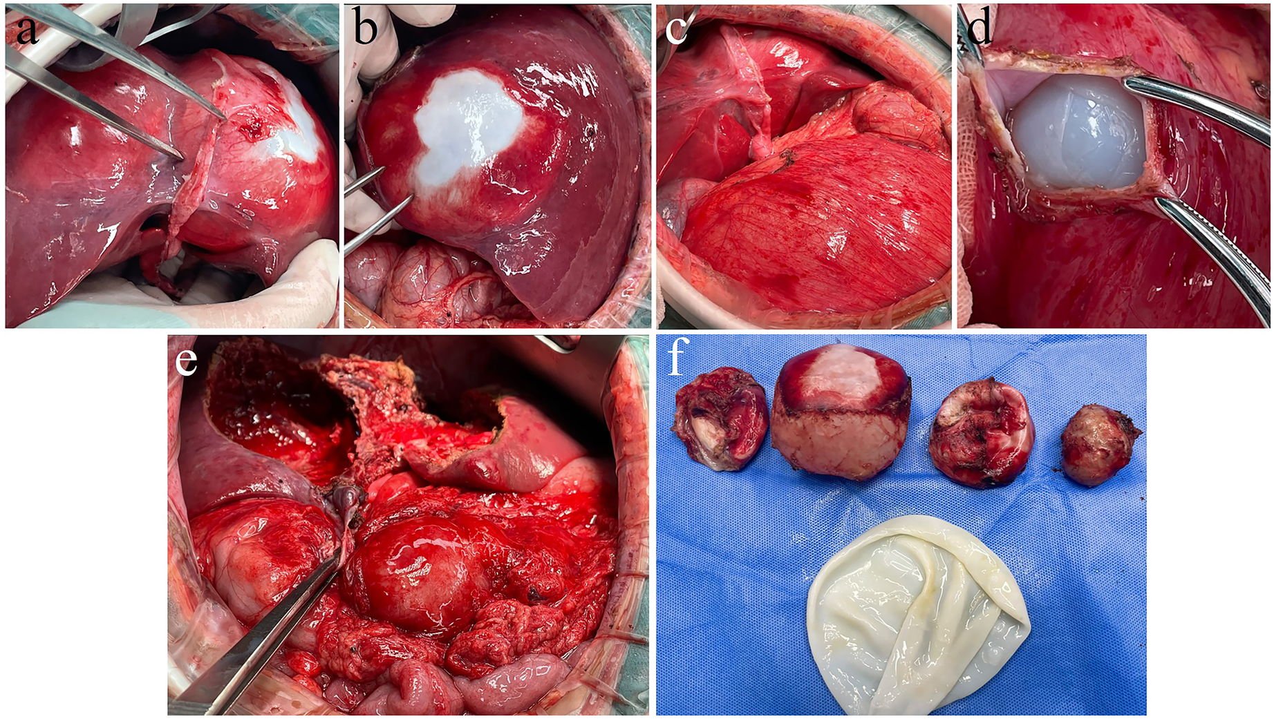 Series of images depicting a surgical procedure. Panels a through e show different stages of the surgery involving tissue and cyst extraction from the liver. Panel f displays several excised masses on a blue surgical cloth, indicating the removed cysts and surrounding tissue, along with a transparent sac-like structure.