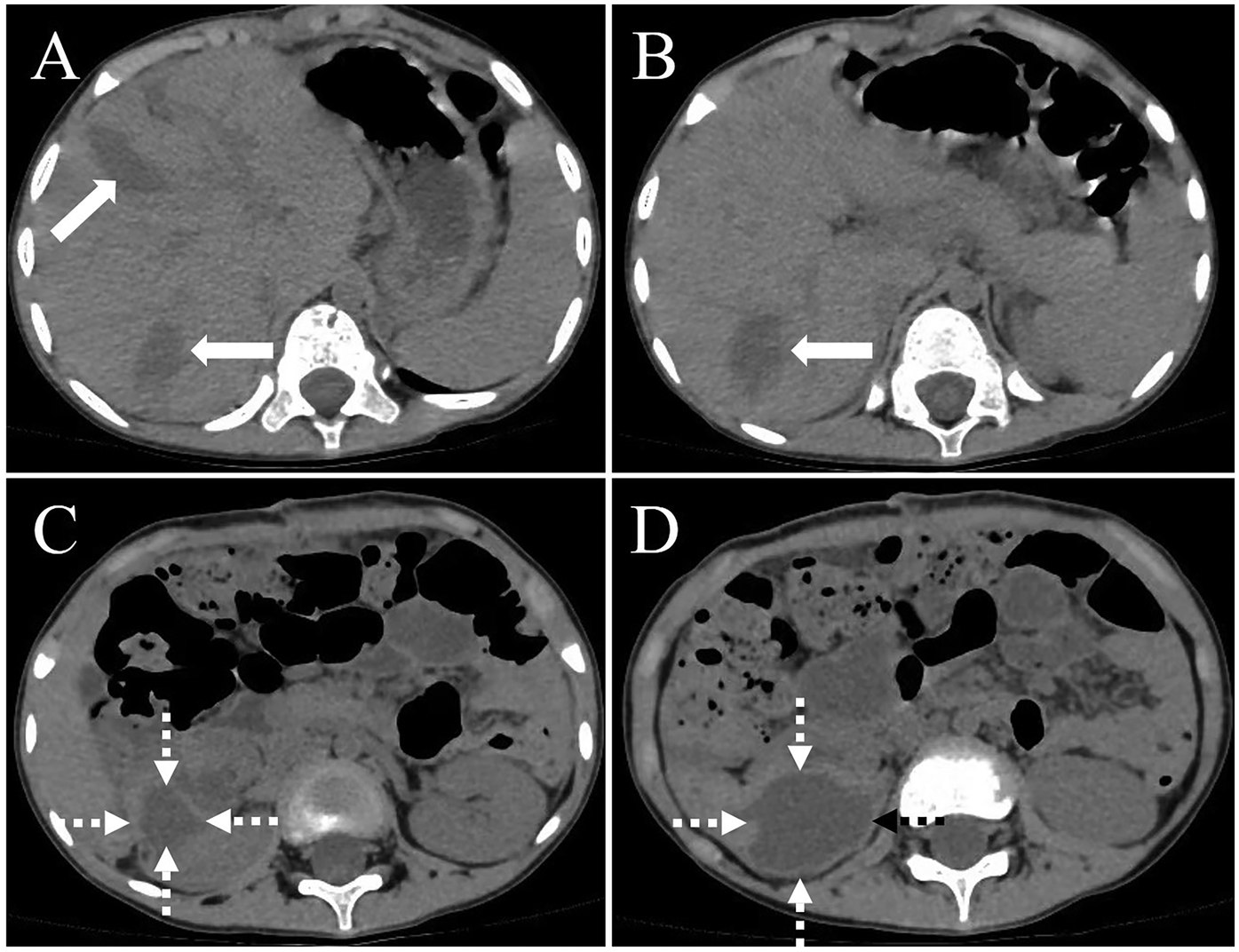 CT scan images labeled A, B, C, and D show abdominal cross-sections. Image A shows two solid arrows indicating areas of interest. Image B has one solid arrow pointing to another area. Images C and D both have dashed arrows highlighting specific sections, possibly contrasting different features within the abdomen.
