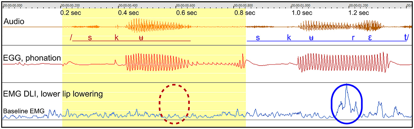 Graph showing audio, electroglottography (EGG) for phonation, and electromyography (EMG) for lower lip lowering over time. The audio waveform displays phonemes “s,” “k,” “u,” “r,” “ε,” and “t” across 1.4 seconds. EGG data show phonation activity, while EMG records muscle activity, highlighting a significant spike circled in blue around 1.1 seconds.