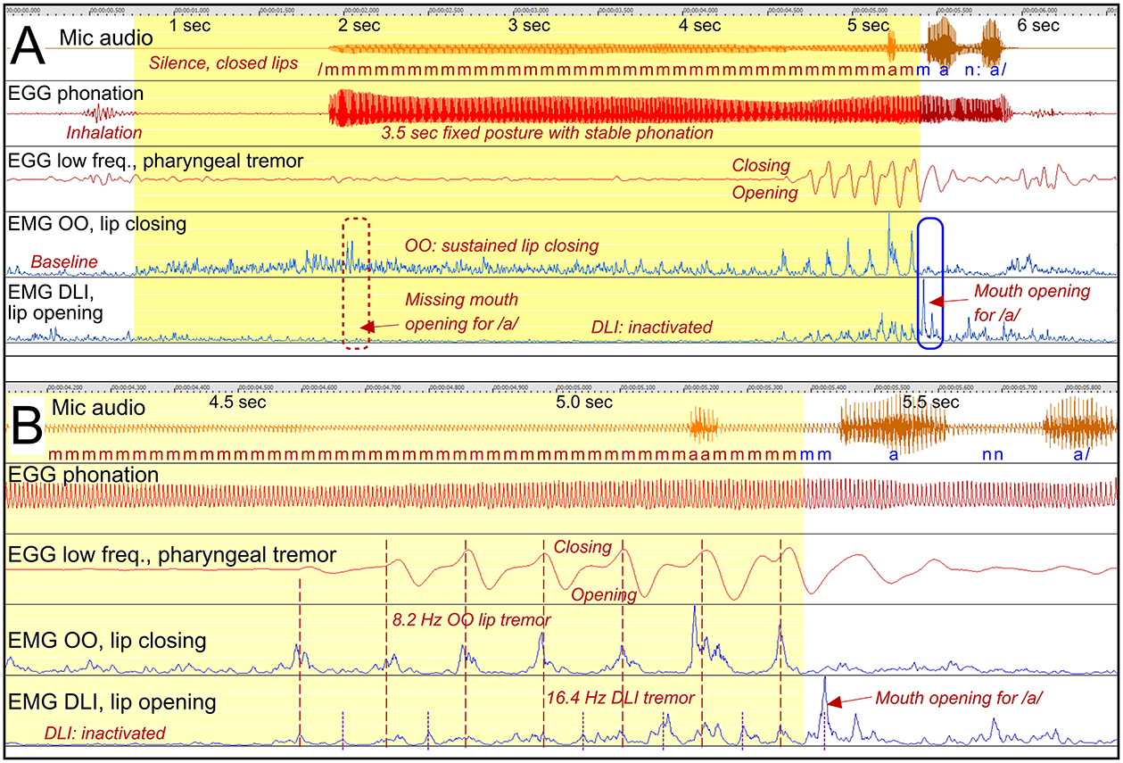 Diagram showing two recordings labeled A and B, displaying phonation and muscle activity data over time. Both include microphone audio, EGG phonation, low frequency pharyngeal tremor, EMG OO for lip closing, and EMG DLI for lip opening. The timeline in A ranges from one to six seconds, highlighting a 3.5-second stable phonation. In B, the timeline ranges from 4.5 to 5.5 seconds, showing lip and mouth tremors with phonetic variations.