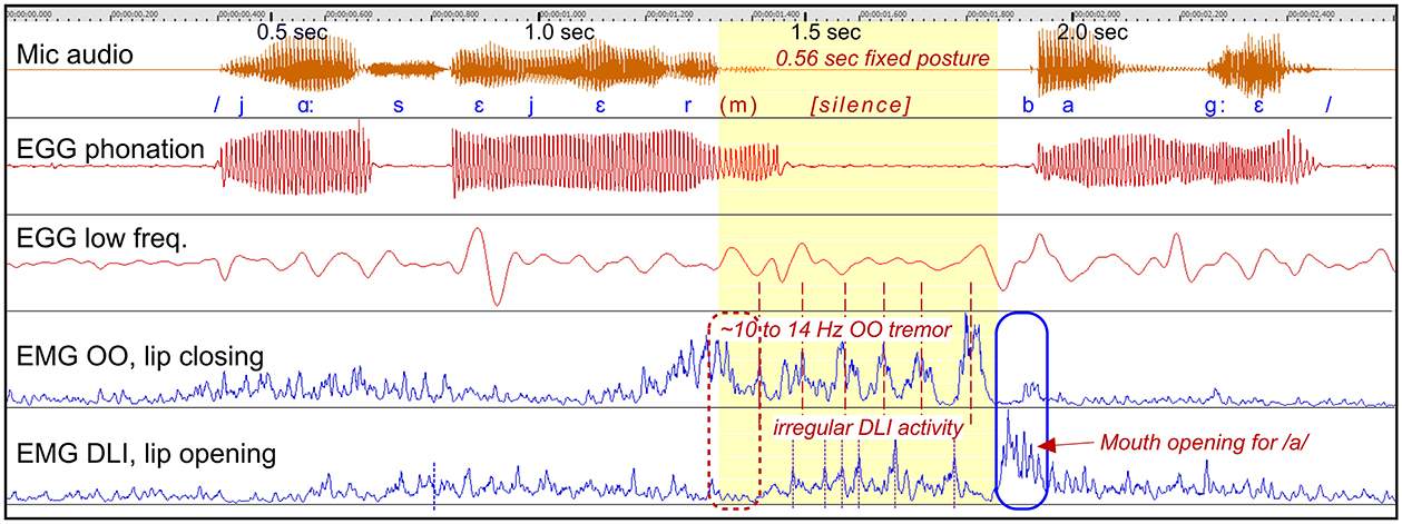 Graph depicting mic audio, EGG phonation, EGG low frequency, EMG orbicularis oris (OO) for lip closing, and EMG depressor labii inferioris (DLI) for lip opening over a two-second period. Key phonetic symbols are labeled along with specific annotations on OO lip tremor and irregular DLI activity. A section indicating mouth opening for the “a” phoneme is highlighted.