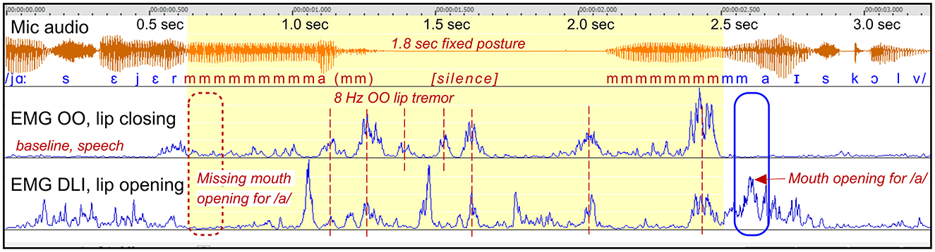 Graph of speech analysis showing mic audio waveform over 3 seconds with corresponding phonetic symbols. Below are two EMG graphs for lip closing (OO) and lip opening (DLI), indicating mouth movements like closing, opening, and tremors at various points. Key events such as “speech stopping” and “mouth opening for /a/” are marked with annotations.