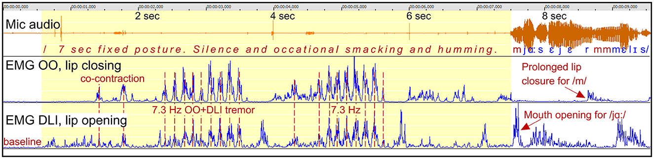 Graph showing audio and EMG data over 10 seconds. Top section displays microphone audio with periods of silence and speech. Middle section is EMG OO data showing lip closing activity with co-contraction and 7.3 Hz tremor. Bottom section is EMG DLI data indicating lip opening with mouth movements marked for /m/ and /p/.