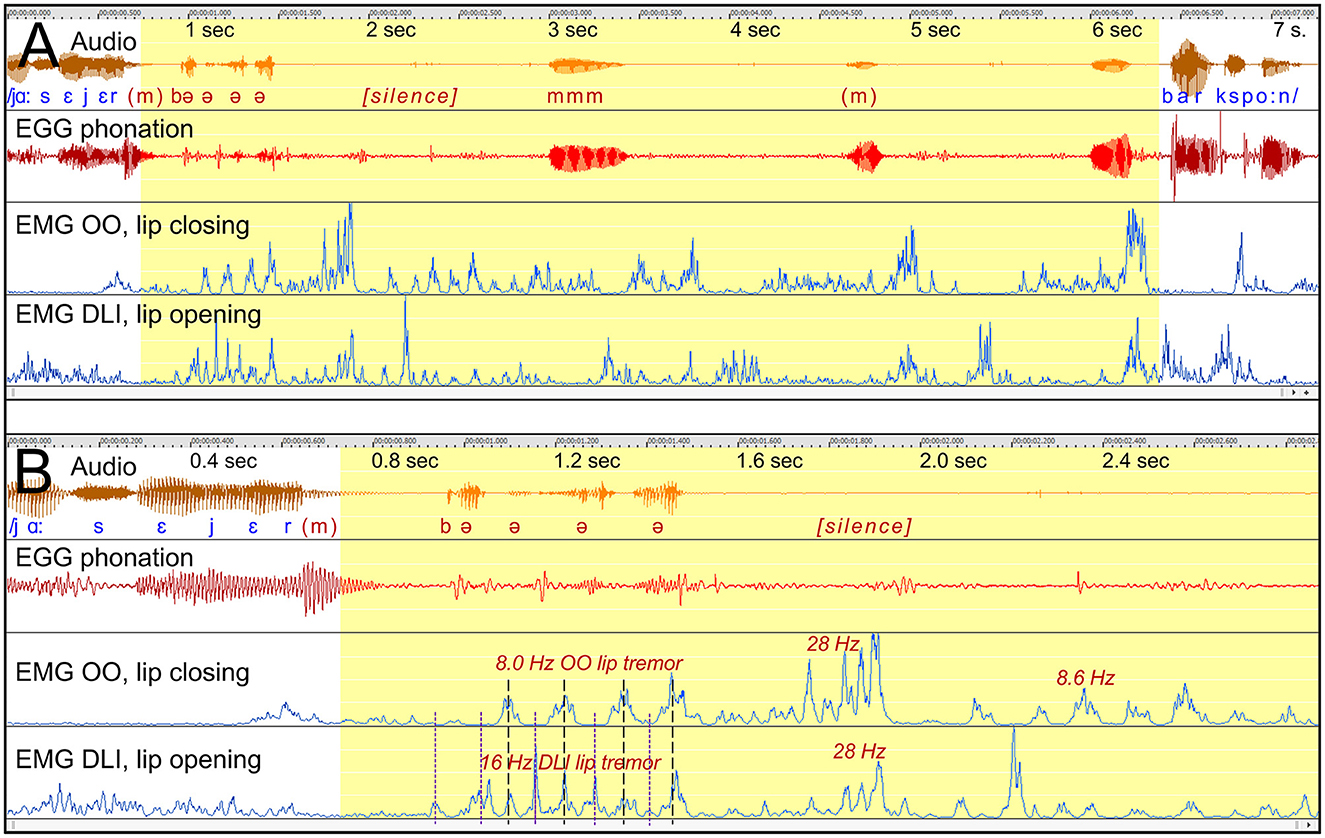 Graphs compare phonation and lip movement during speech for two conditions labeled A and B. Audio waveforms, electroglottography (EGG) phonation, and electromyography (EMG) for lip closing (OO) and opening (DLI) are depicted. Different sound segments and silences are marked, with frequencies for lip tremors labeled in section B. Time is shown in seconds.