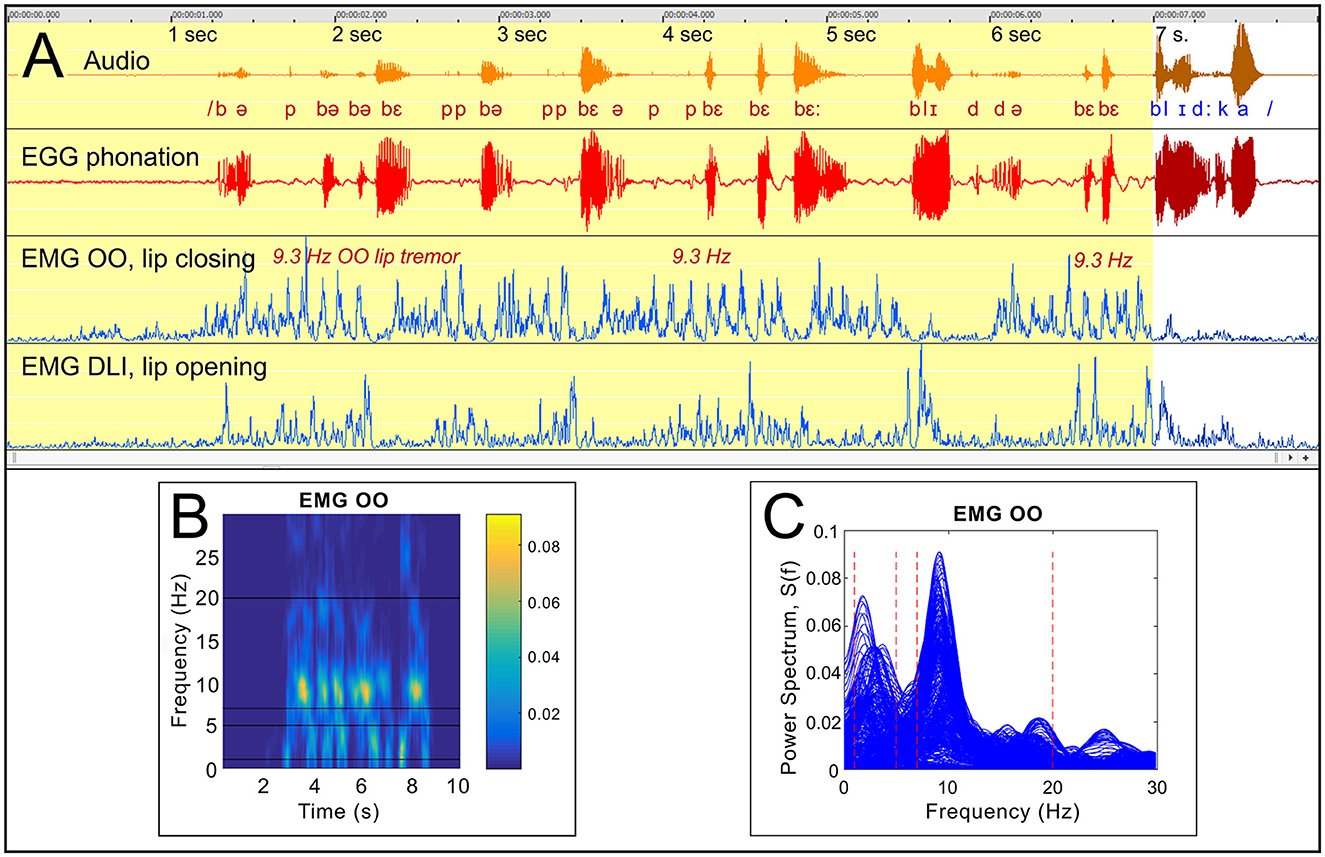 Panel A shows several waveforms, including audio, EGG phonation, and EMG signals for lip closing and opening, with annotations and a 9.3 Hz tremor frequency noted. Panel B displays a spectrogram of EMG OO over time with frequency intensity in color. Panel C shows a power spectrum graph for EMG OO, highlighting peaks around specific frequencies.