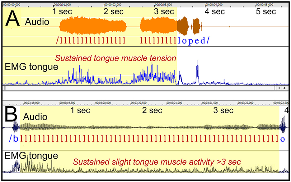 Diagram comparing audio and EMG tongue muscle activity in two panels. Panel A shows sustained tongue muscle tension during speech with distinct audio peaks. Panel B depicts slight tongue muscle activity with prolonged muscle activity over three seconds, visible through smaller audio peaks.