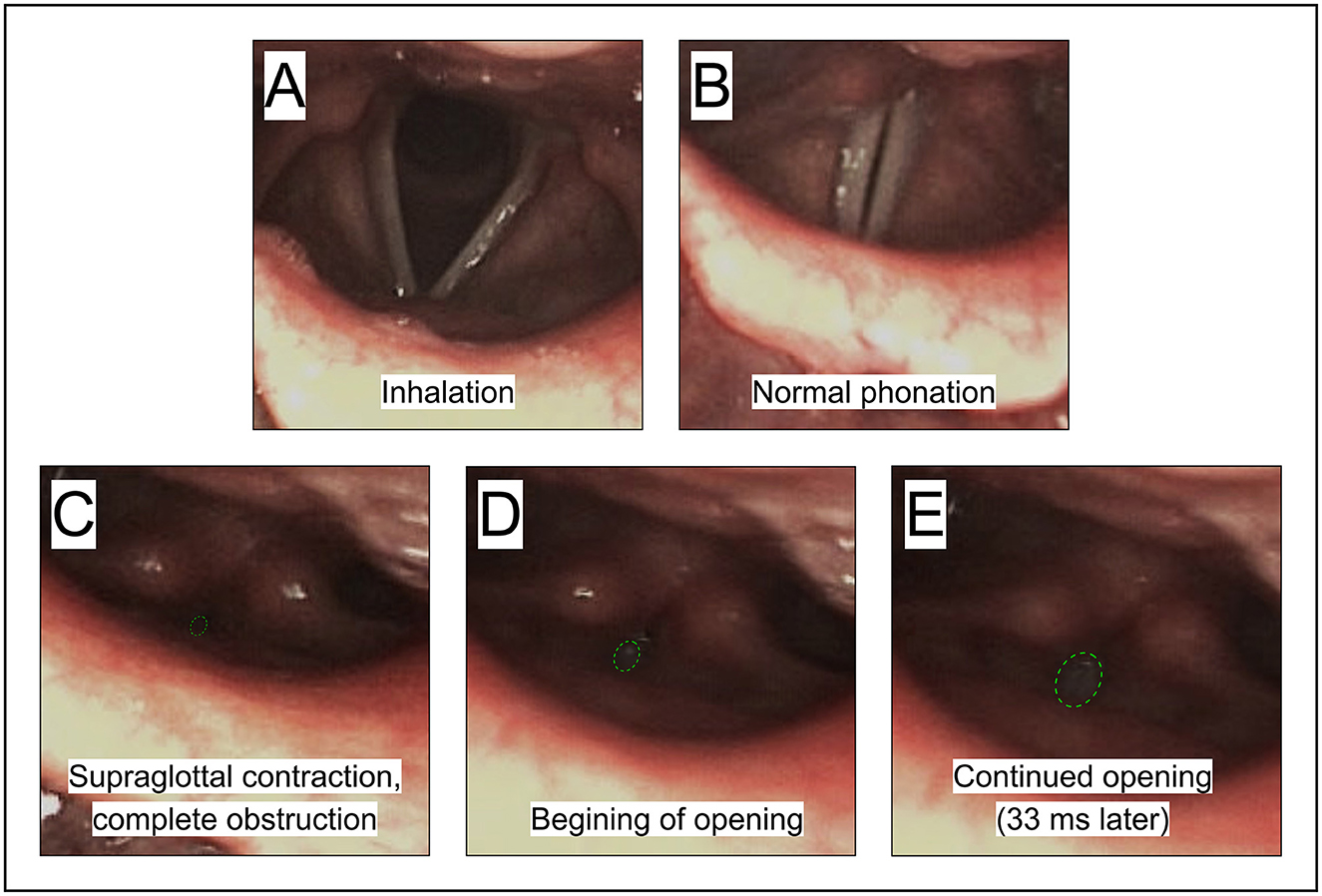 Images A through E show a sequence of vocal cord positions. A depicts inhalation with open vocal cords. B shows normal phonation with slightly closed cords. C illustrates supraglottal contraction causing complete obstruction. D shows the beginning of opening, while E displays continued opening thirty-three milliseconds later.