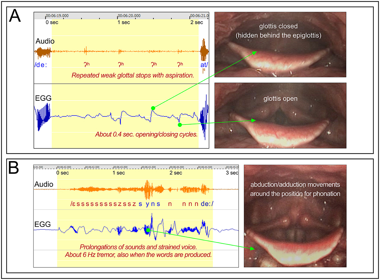 Panel A shows audio and EGG signals of repeated weak glottal stops with aspiration, alongside images of the glottis closed and open. Panel B displays audio and EGG signals with prolongations of sounds, indicating a 6 Hz tremor, with an image illustrating glottis abduction/adduction movements during phonation.
