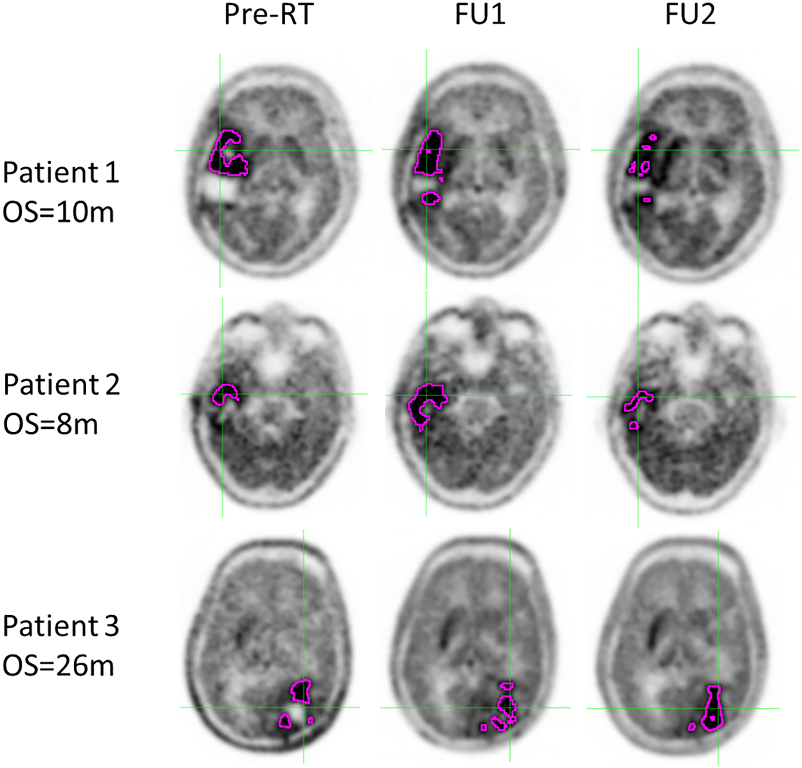 Three rows of brain scan images for three patients labeled Patient 1, Patient 2, and Patient 3. Each row contains three images labeled Pre-RT, FU1, and FU2. Pink outlines highlight specific areas on each scan. Patient 1 has an overall survival (OS) of ten months, Patient 2 has eight months, and Patient 3 has twenty-six months.