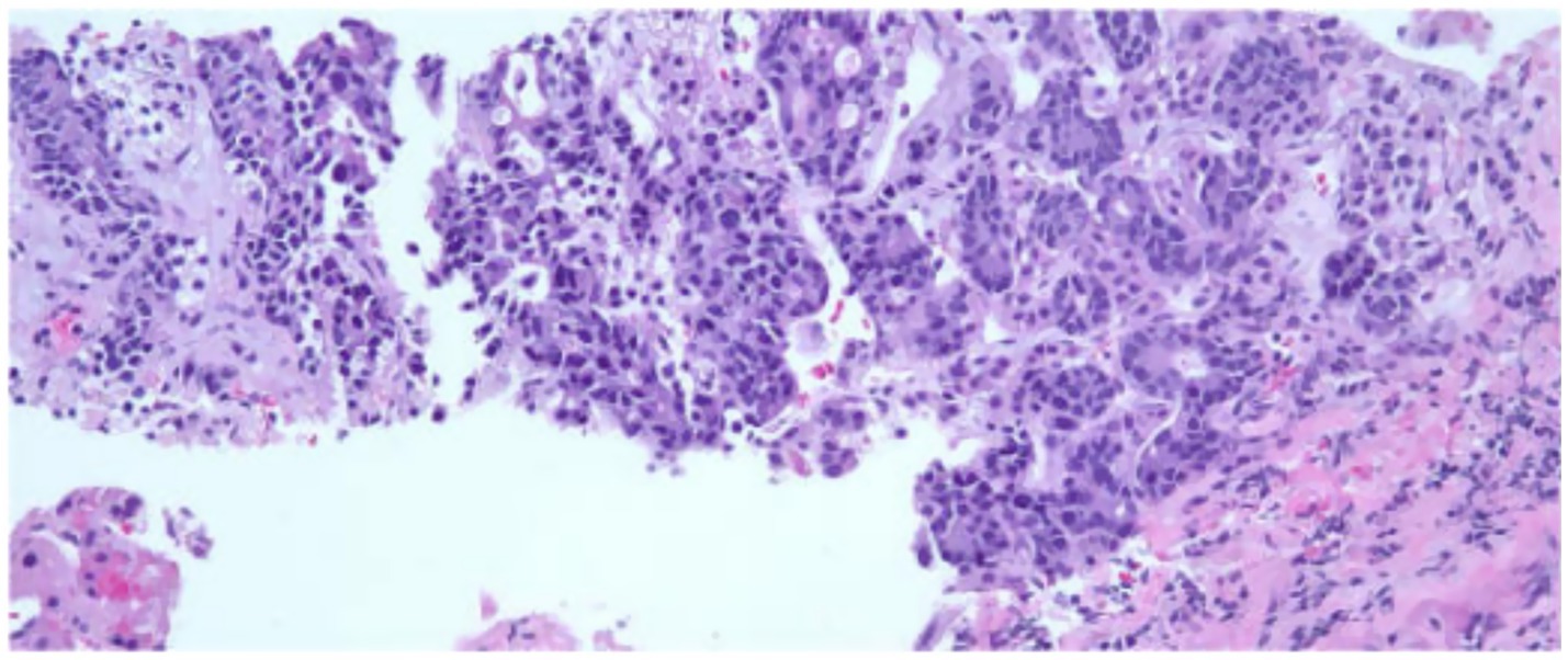 Histological image showing a section of tissue stained with hematoxylin and eosin. The cells appear in varying shades of purple, with tightly packed, irregular shapes, indicative of a possible pathological condition.