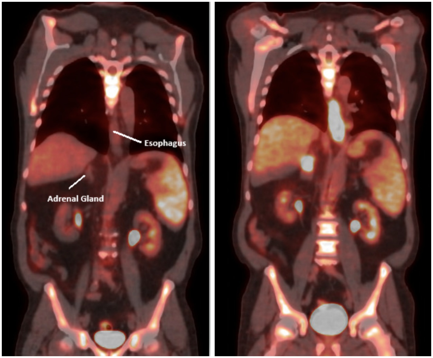 Two medical scans show cross-sectional views of the upper abdomen. The left image labels the esophagus and adrenal gland. Both images highlight organs with variation in brightness indicating different tissue densities.