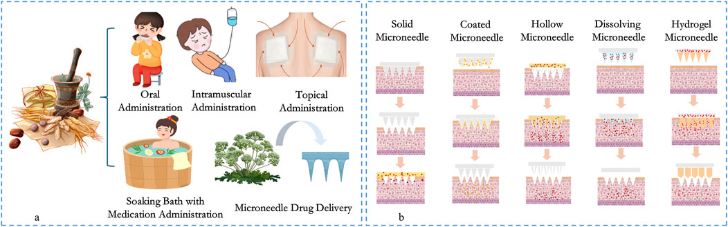 Illustration comparing drug administration methods. Left side depicts traditional methods: oral, intramuscular, topical, soaking bath, and microneedle drug delivery. Right side shows various microneedle types: solid, coated, hollow, dissolving, and hydrogel, with cross-section diagrams of skin penetration and drug release.