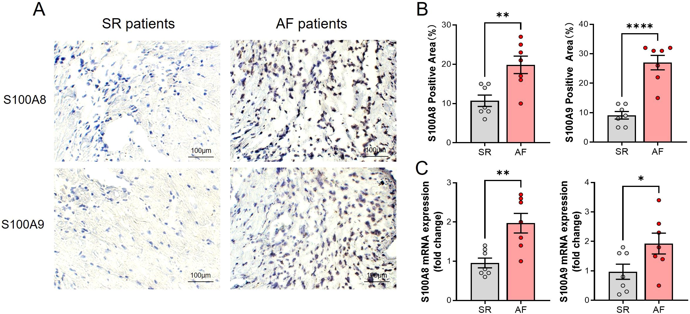 Panel A shows microscopic images of heart tissue stained for S100A8 and S100A9 from SR and AF patients, with darker staining in AF samples. Panel B displays bar graphs comparing the S100A8 and S100A9 positive areas as percentages, showing significantly higher values in AF patients. Panel C features bar graphs of S100A8 and S100A9 mRNA expression fold changes, also indicating higher expression in AF patients. Significance levels are noted with asterisks.