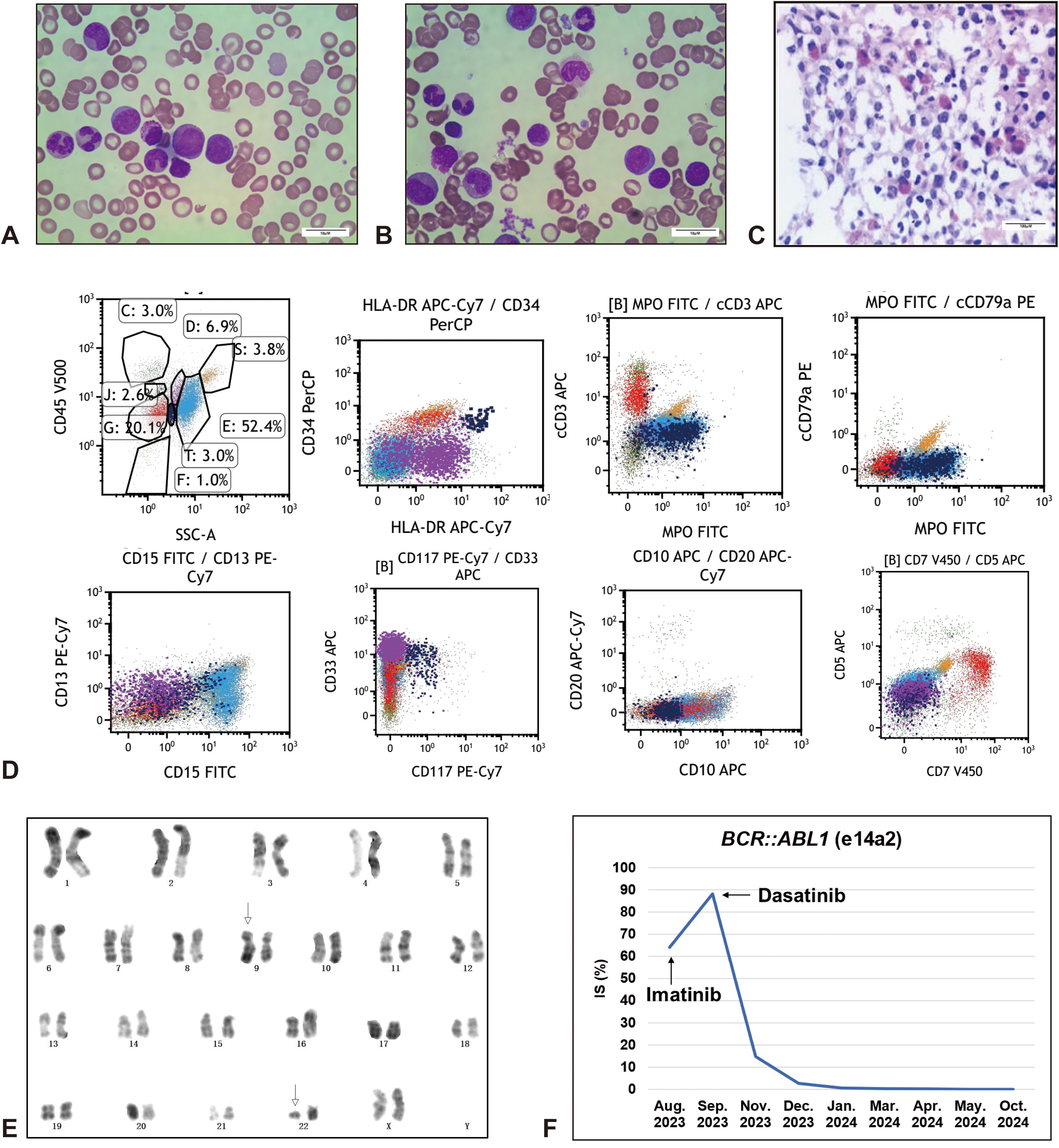Panel of images and graphs depicting hematological analyses. A and B show blood smears with various cell types stained in purple against a green background. C shows a higher magnification of stained cells within tissue. D presents flow cytometry scatter plots with different color-coded cell populations. E displays a karyotype with numbered chromosomes. F shows a line graph tracking BCR::ABL1 levels over time, indicating significant reduction after treatment with Imatinib and Dasatinib.