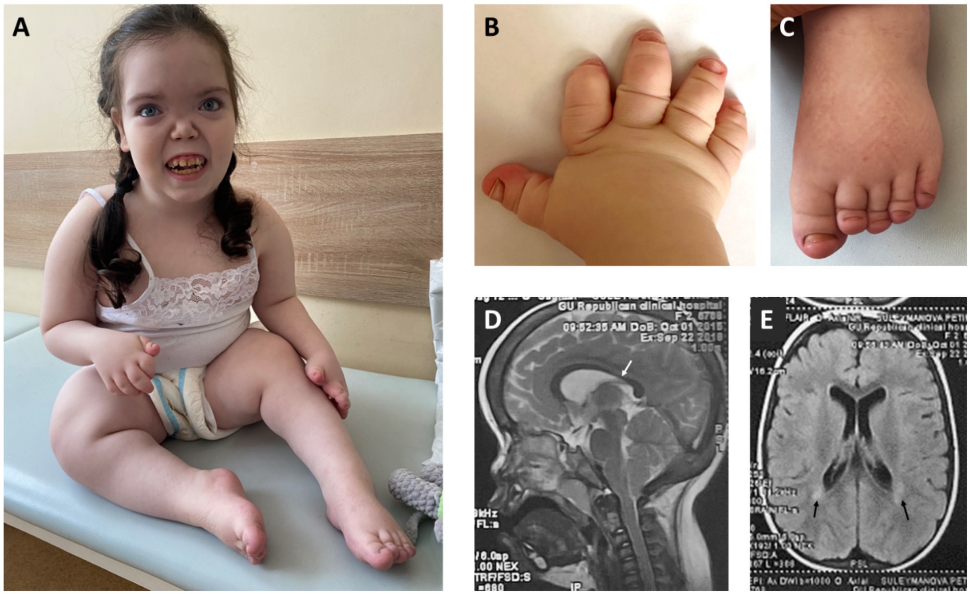 Panel A shows a young child with dark hair sitting on an examination table wearing a white garment. Panel B displays a close-up of a hand with five!! fingers. Panel C shows a foot with short toes. Panels D and E are MRI scans of a brain, highlighting specific areas with arrows.