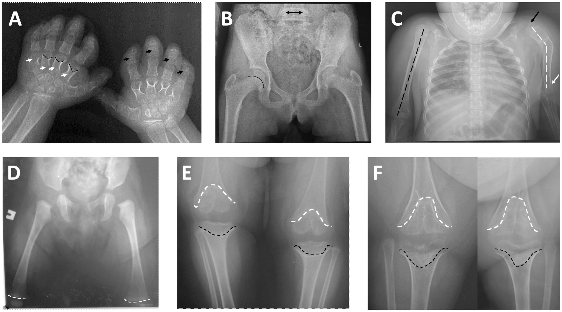 X-ray images showcasing various skeletal regions with annotations. Image A shows hands with marked bone structures. Image B displays the pelvis with a marked arrow and curvature. Image C shows the upper torso and arms with arrows indicating bone alignment. Image D depicts the hips with lines marking the femur. Images E and F focus on knee joints with dashed lines outlining bone contours.