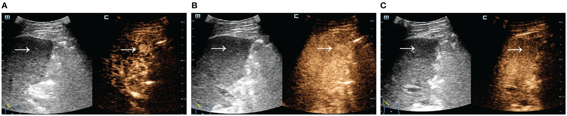 Ultrasound images display a liver with arrows indicating focal liver lesions. The left pair are in grayscale and contrast-enhanced, highlighting vascular structures. The right pair show similar enhancements and lesion visibility. Each image set shows differences in texture and structure with contrast use.