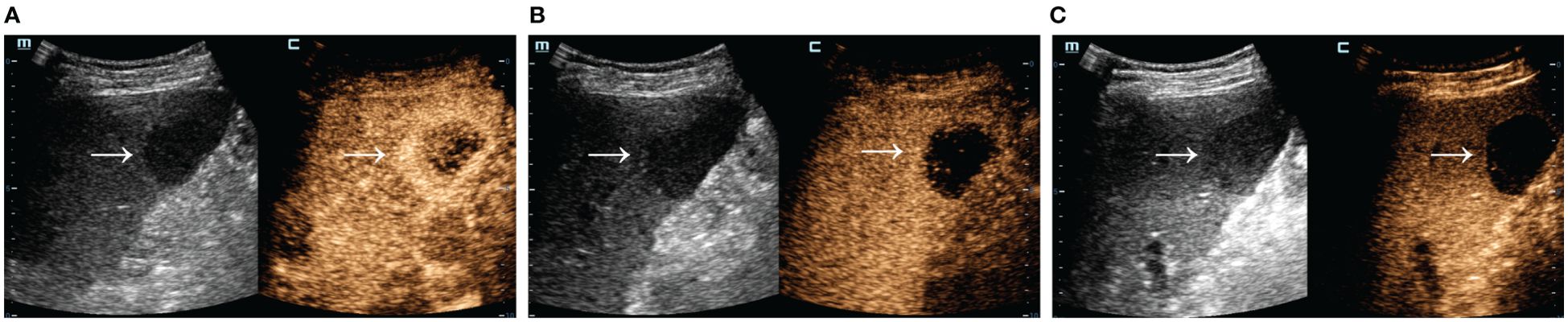 Ultrasound images showing two series of liver scans with contrast enhancement. The left series includes a grayscale image followed by an enhanced image with a darker area indicated by arrows. The right series is similar, with the grayscale and enhanced images highlighting a circular dark region.