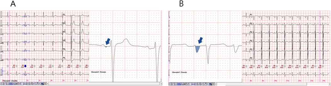 Two ECG tracings, labeled A and B.They are a comparison of normal and abnormal.